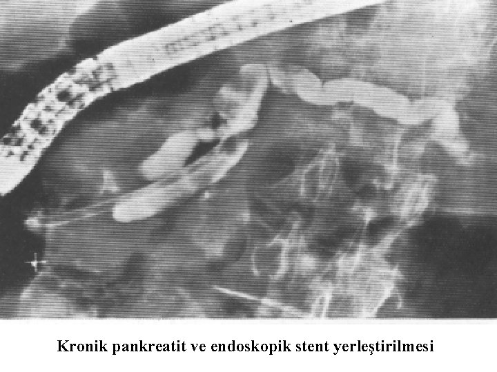 Kronik pankreatit ve endoskopik stent yerleştirilmesi 