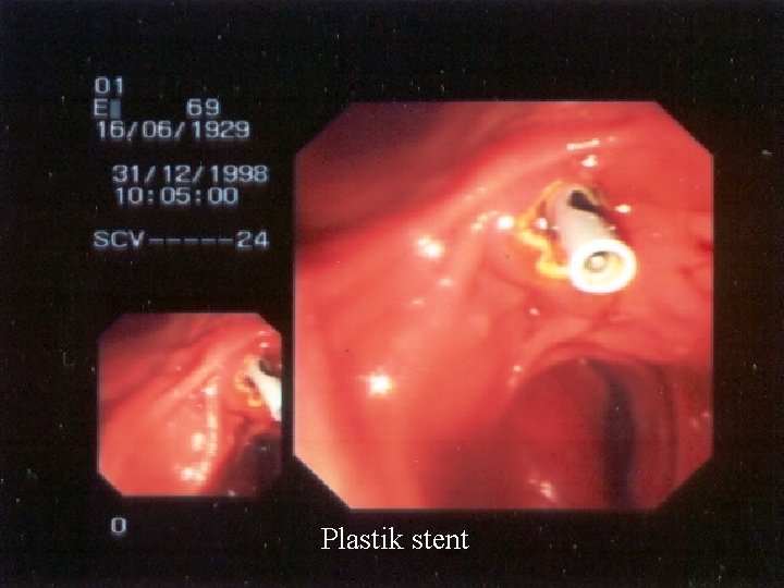 Plastik stent 