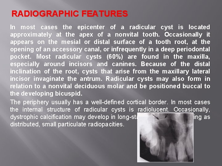 RADIOGRAPHIC FEATURES In most cases the epicenter of a radicular cyst is located approximately