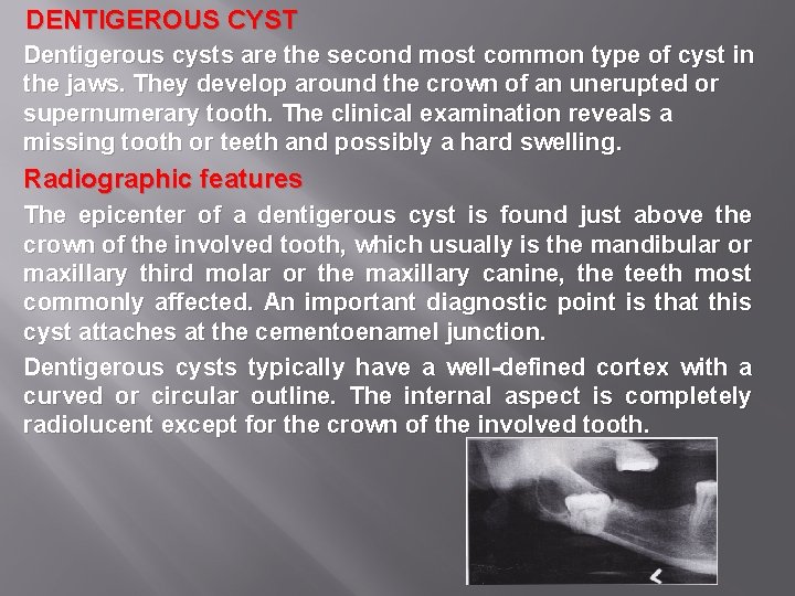 DENTIGEROUS CYST Dentigerous cysts are the second most common type of cyst in the