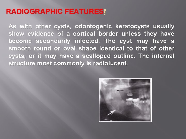 RADIOGRAPHIC FEATURES As with other cysts, odontogenic keratocysts usually show evidence of a cortical