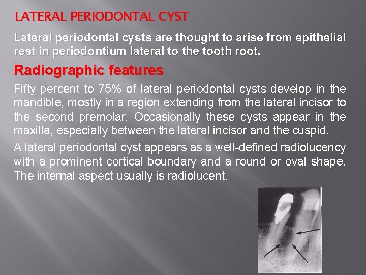 LATERAL PERIODONTAL CYST Lateral periodontal cysts are thought to arise from epithelial rest in