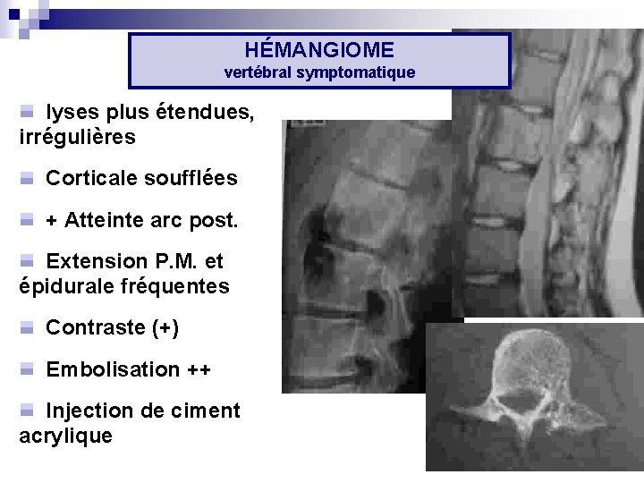 HÉMANGIOME vertébral symptomatique lyses plus étendues, irrégulières Corticale soufflées + Atteinte arc post. Extension HÉMANGIOME vertébral symptomatique lyses plus étendues, irrégulières Corticale soufflées + Atteinte arc post. Extension