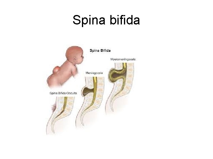 Spina bifida Spina bifida