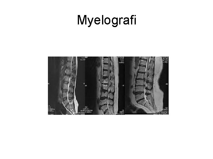 Myelografi Myelografi
