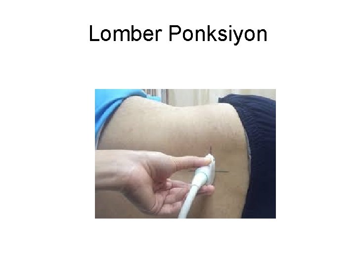 Lomber Ponksiyon Lomber Ponksiyon