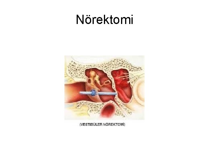Nörektomi Nörektomi