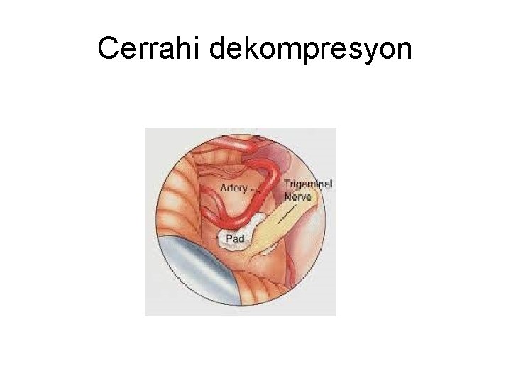Cerrahi dekompresyon Cerrahi dekompresyon