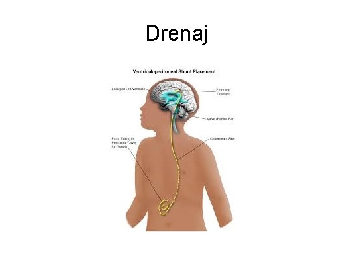 Drenaj Drenaj