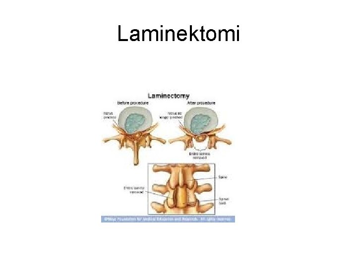 Laminektomi Laminektomi