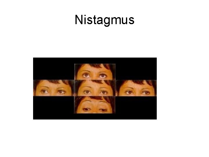 Nistagmus Nistagmus