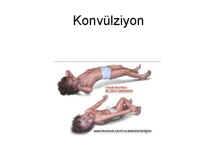 Konvülziyon Konvülziyon