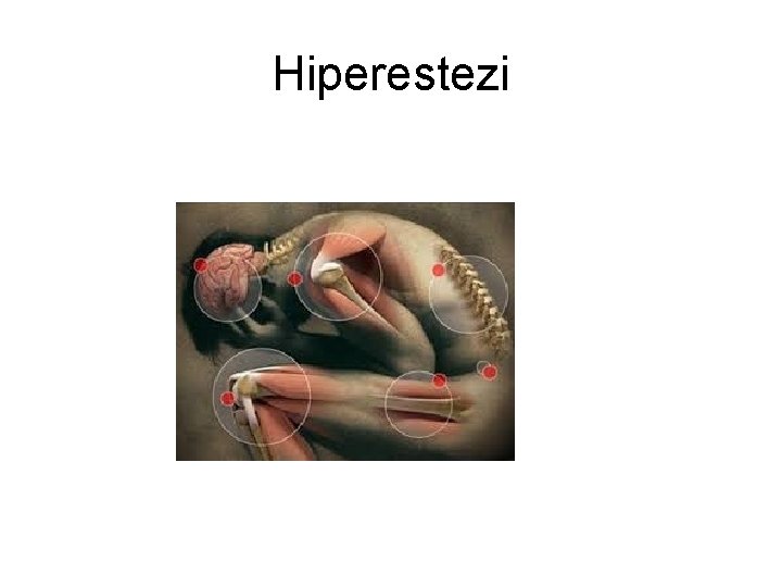 Hiperestezi Hiperestezi