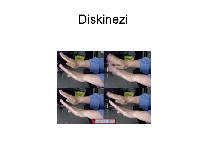Diskinezi Diskinezi