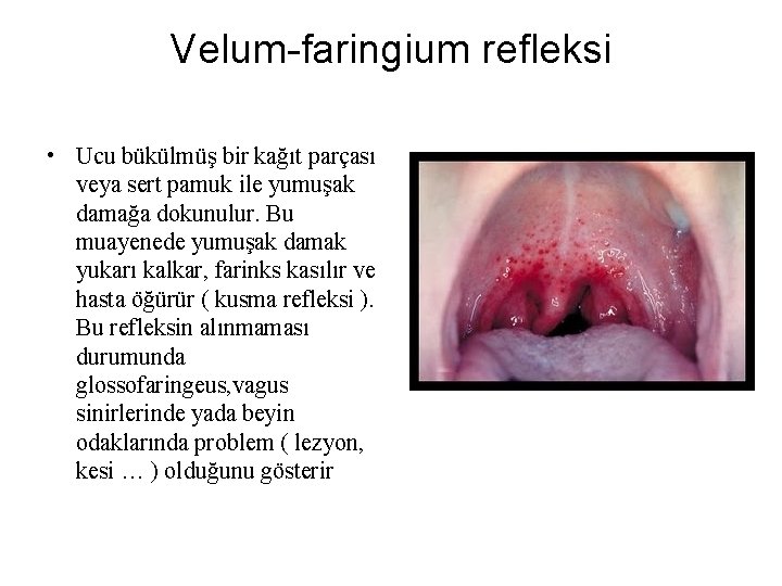 Velum-faringium refleksi • Ucu bükülmüş bir kağıt parçası veya sert pamuk ile yumuşak damağa Velum-faringium refleksi • Ucu bükülmüş bir kağıt parçası veya sert pamuk ile yumuşak damağa