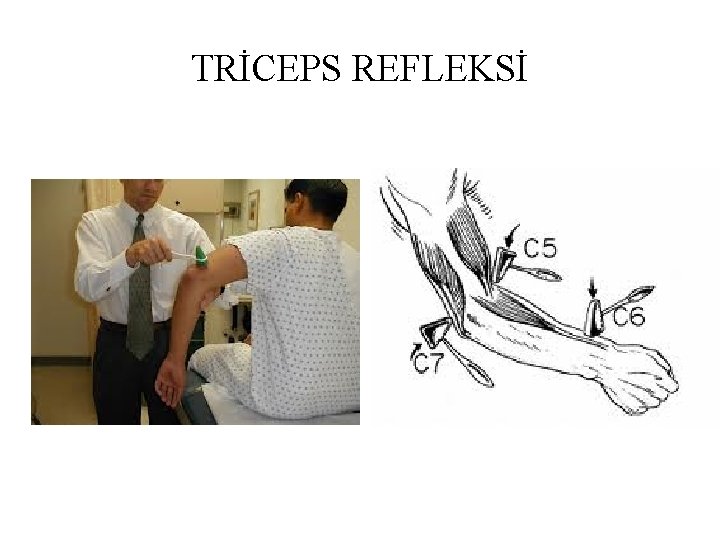 TRİCEPS REFLEKSİ TRİCEPS REFLEKSİ