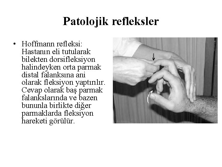 Patolojik refleksler • Hoffmann refleksi: Hastanın eli tutularak bilekten dorsifleksiyon halindeyken orta parmak distal Patolojik refleksler • Hoffmann refleksi: Hastanın eli tutularak bilekten dorsifleksiyon halindeyken orta parmak distal