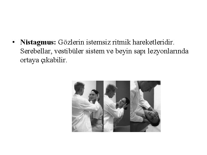 • Nistagmus: Gözlerin istemsiz ritmik hareketleridir. Serebellar, vestibüler sistem ve beyin sapı lezyonlarında • Nistagmus: Gözlerin istemsiz ritmik hareketleridir. Serebellar, vestibüler sistem ve beyin sapı lezyonlarında