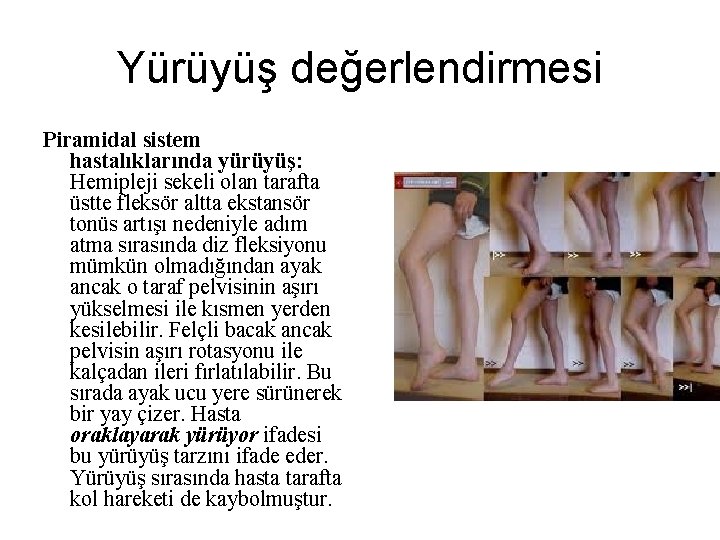 Yürüyüş değerlendirmesi Piramidal sistem hastalıklarında yürüyüş: Hemipleji sekeli olan tarafta üstte fleksör altta ekstansör Yürüyüş değerlendirmesi Piramidal sistem hastalıklarında yürüyüş: Hemipleji sekeli olan tarafta üstte fleksör altta ekstansör