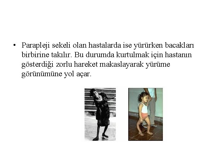 • Parapleji sekeli olan hastalarda ise yürürken bacakları birbirine takılır. Bu durumda kurtulmak • Parapleji sekeli olan hastalarda ise yürürken bacakları birbirine takılır. Bu durumda kurtulmak
