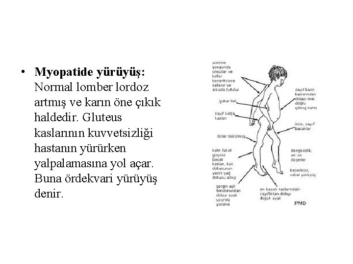 • Myopatide yürüyüş: Normal lomber lordoz artmış ve karın öne çıkık haldedir. Gluteus • Myopatide yürüyüş: Normal lomber lordoz artmış ve karın öne çıkık haldedir. Gluteus