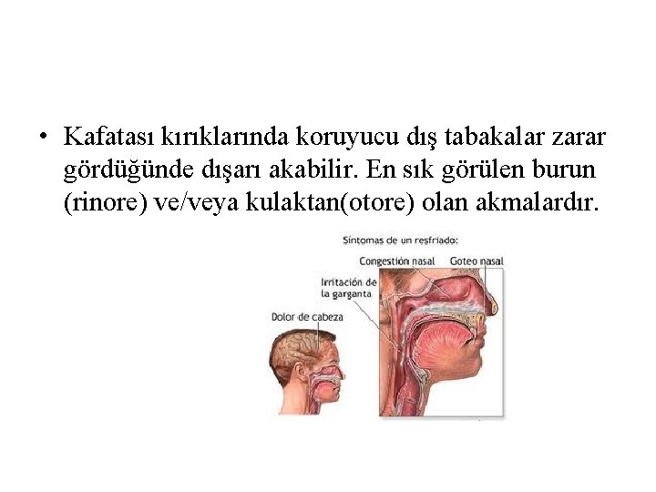 • Kafatası kırıklarında koruyucu dış tabakalar zarar gördüğünde dışarı akabilir. En sık görülen • Kafatası kırıklarında koruyucu dış tabakalar zarar gördüğünde dışarı akabilir. En sık görülen