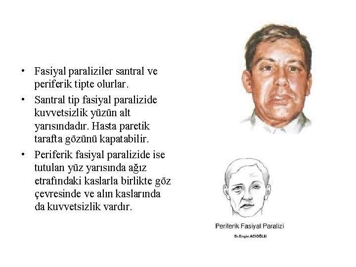 • Fasiyal paraliziler santral ve periferik tipte olurlar. • Santral tip fasiyal paralizide • Fasiyal paraliziler santral ve periferik tipte olurlar. • Santral tip fasiyal paralizide