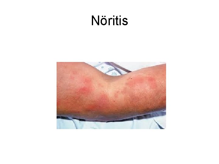 Nöritis Nöritis