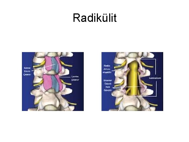 Radikülit Radikülit