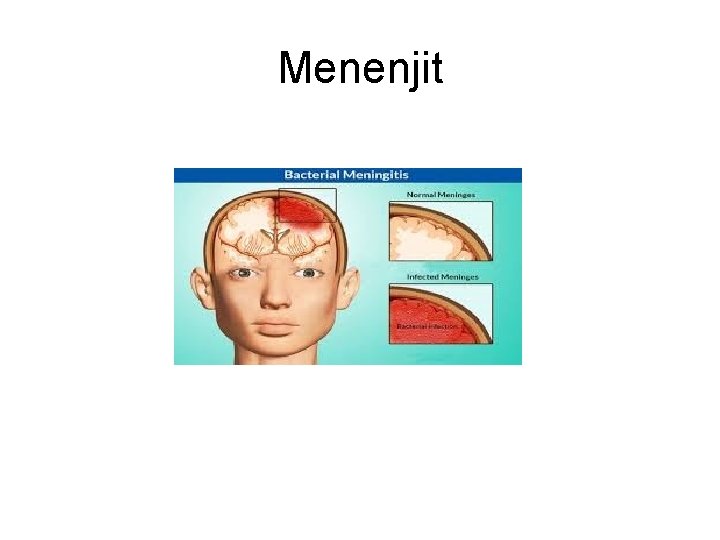 Menenjit Menenjit