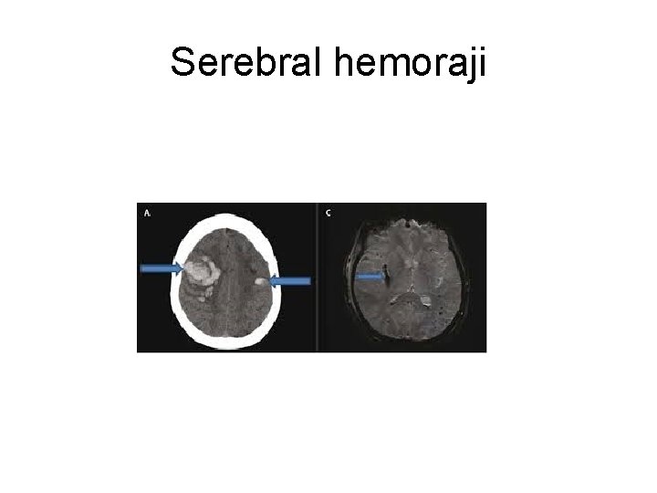 Serebral hemoraji Serebral hemoraji