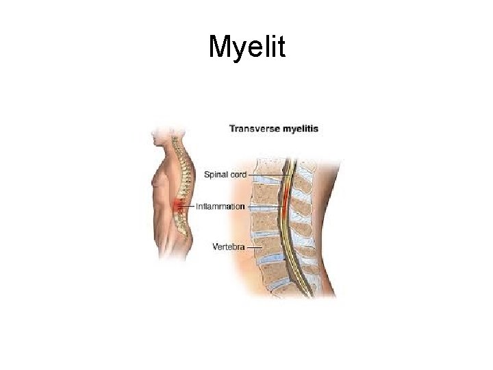 Myelit Myelit