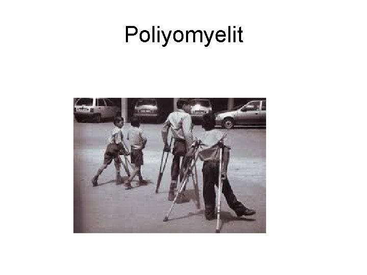 Poliyomyelit Poliyomyelit