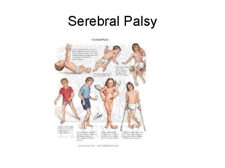 Serebral Palsy Serebral Palsy