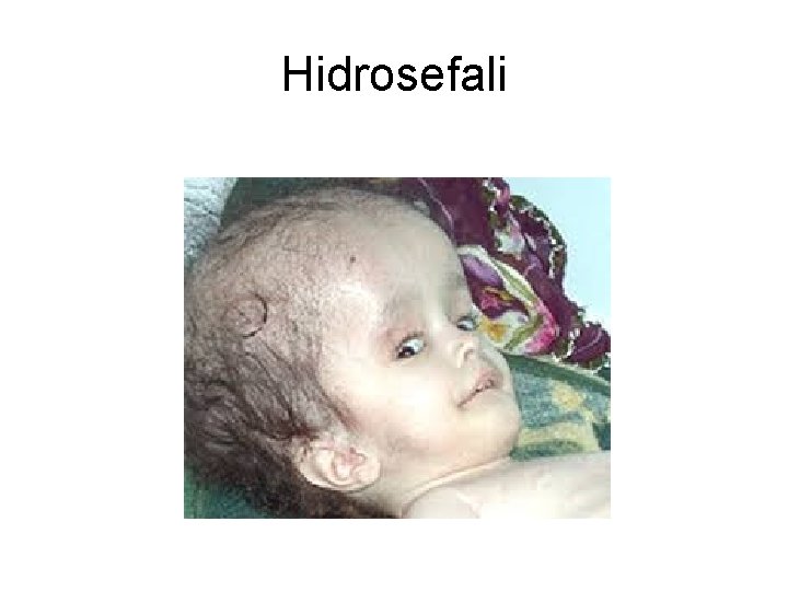 Hidrosefali Hidrosefali