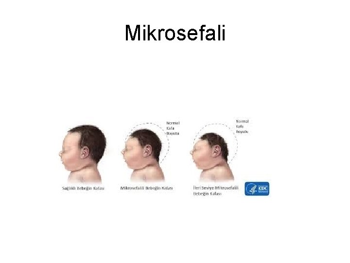 Mikrosefali Mikrosefali