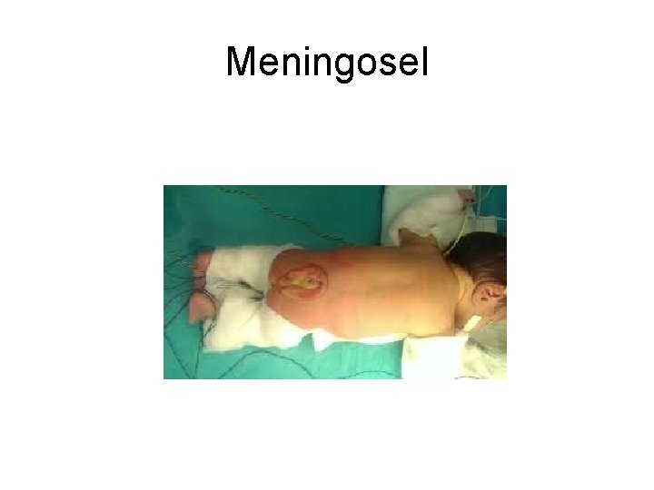 Meningosel Meningosel