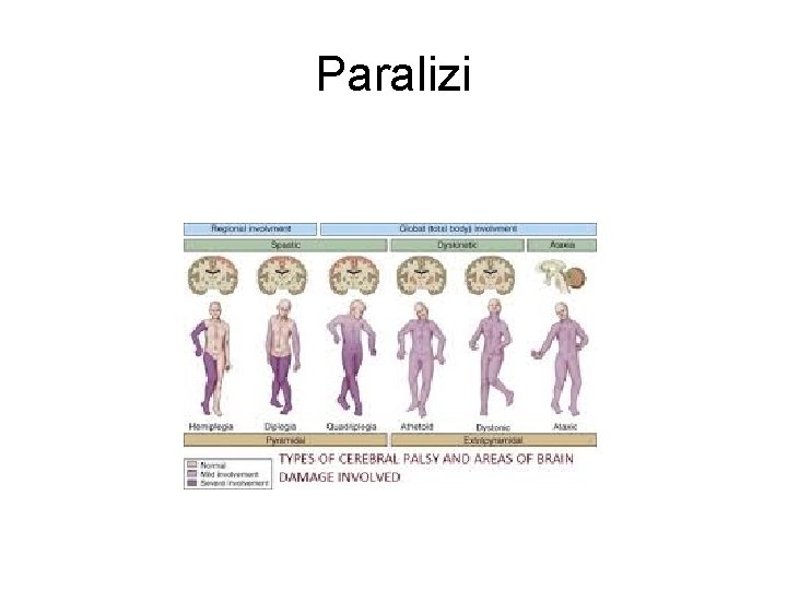 Paralizi Paralizi