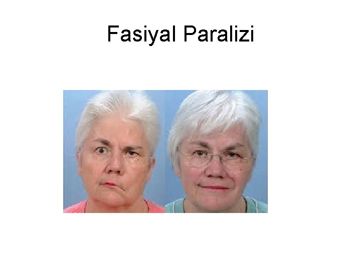 Fasiyal Paralizi Fasiyal Paralizi