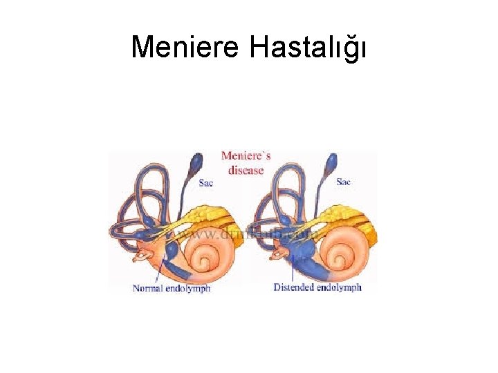 Meniere Hastalığı Meniere Hastalığı