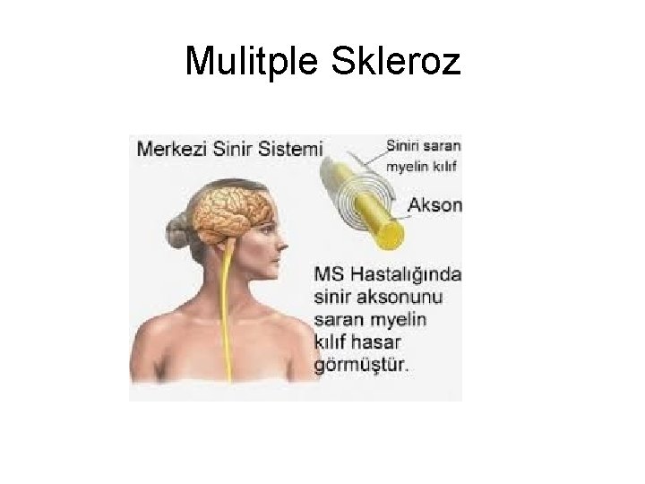 Mulitple Skleroz Mulitple Skleroz