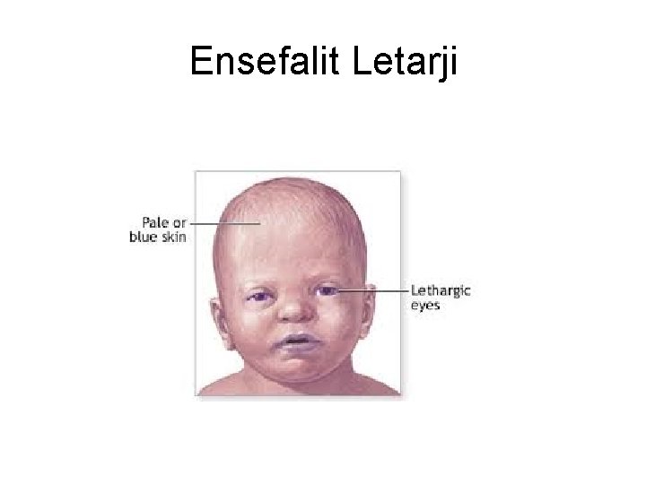 Ensefalit Letarji Ensefalit Letarji