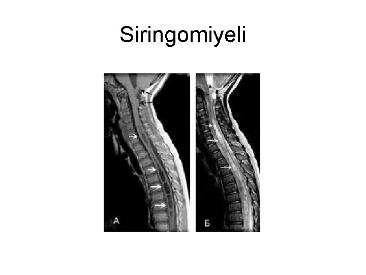 Siringomiyeli Siringomiyeli