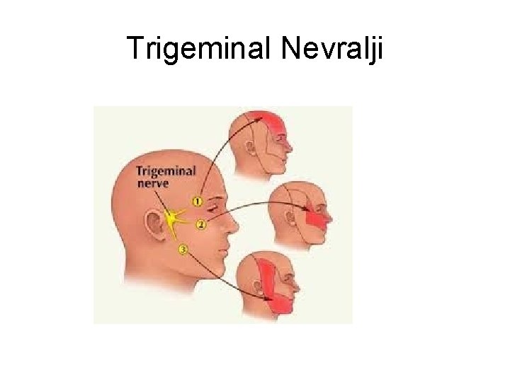 Trigeminal Nevralji Trigeminal Nevralji