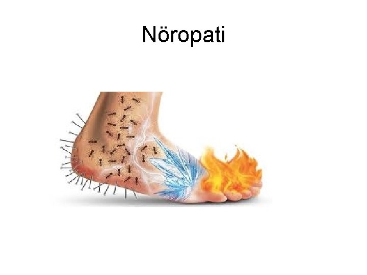 Nöropati Nöropati