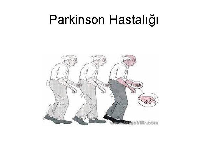 Parkinson Hastalığı Parkinson Hastalığı