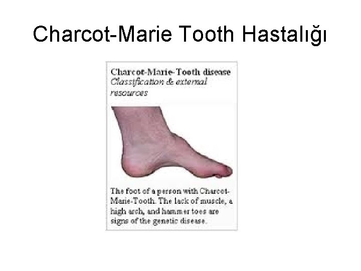 Charcot-Marie Tooth Hastalığı Charcot-Marie Tooth Hastalığı