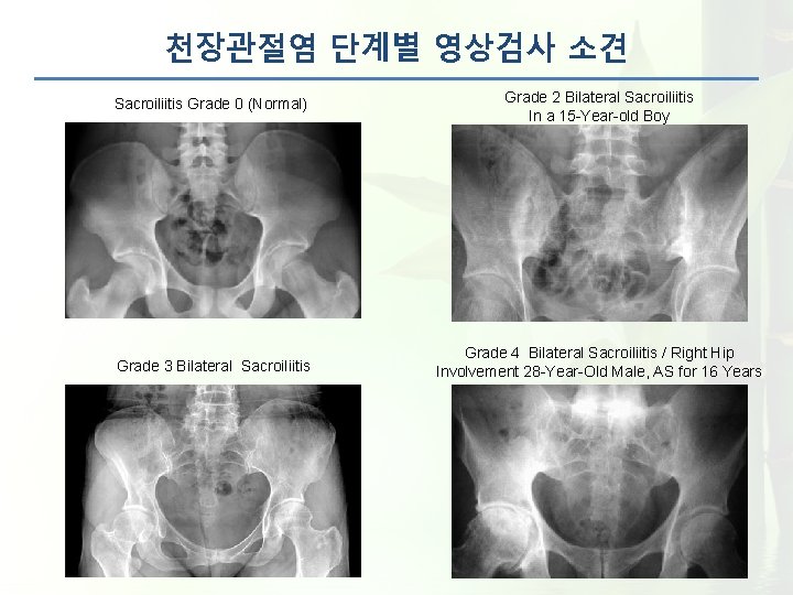 천장관절염 단계별 영상검사 소견 Sacroiliitis Grade 0 (Normal) Grade 2 Bilateral Sacroiliitis In a