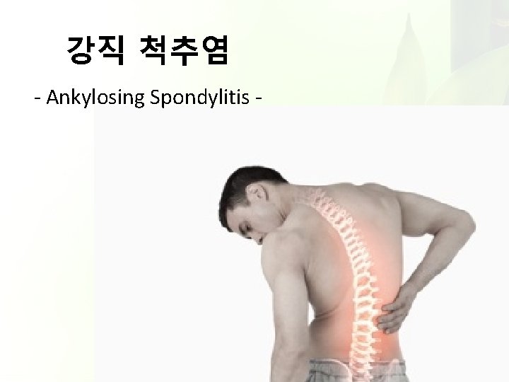 강직 척추염 - Ankylosing Spondylitis - 