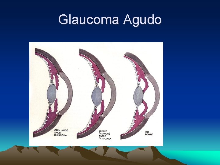 Glaucoma Agudo Glaucoma Agudo